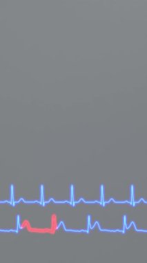 Sağlıklı bir hastanın kalp ritminin EKG 'si ve miyokard enfarktüsü olan bir hastanın EKG' si.