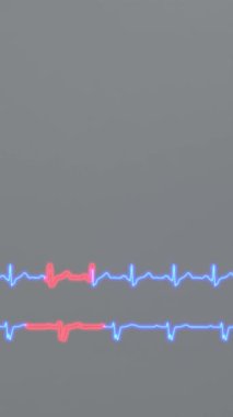 Kalp aritmilerinin EKG 'si. Sağ bohça dal bloğu ve sol bohça dal bloğu