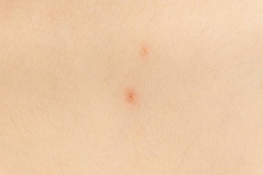 Suçiçeği olan makro deri, farklı aşamalarda Vesicles.