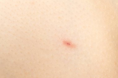 Suçiçeği olan makro deri, farklı aşamalarda Vesicles.