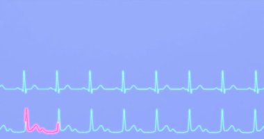 Kalp ritmi ve AV bloğunun EKG karşılaştırması. Canlandırma 3B canlandırma
