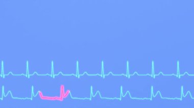 Sağlıklı bir hastanın kalp ritminin EKG 'si ve miyokard enfarktüsü olan bir hastanın EKG' si.