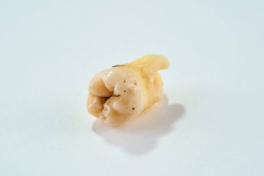 Çıkarılmış diş orijinal halinde ve beyaz arka planda