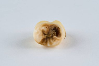 Çıkarılmış diş orijinal halinde ve beyaz arka planda