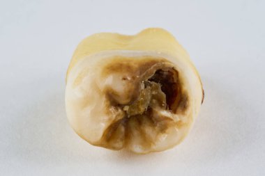 Çıkarılmış diş orijinal halinde ve beyaz arka planda