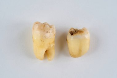 Çıkarılmış diş orijinal halinde ve beyaz arka planda