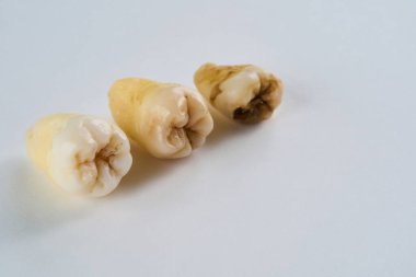 Çıkarılmış diş orijinal halinde ve beyaz arka planda