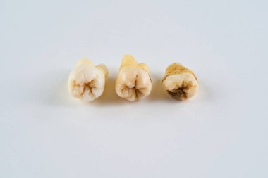 Çıkarılmış diş orijinal halinde ve beyaz arka planda