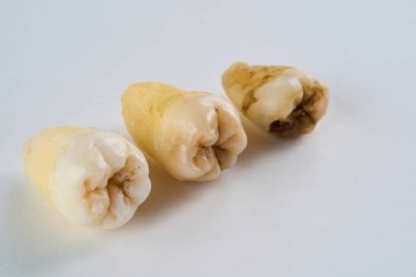 Çıkarılmış diş orijinal halinde ve beyaz arka planda