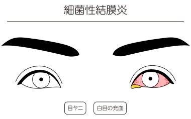 Medikal Clipart, Göz Hastalığı ve Bakteriyel konjonktivitenin Çizim İllüstrasyonu, Vektör İllüstrasyonu