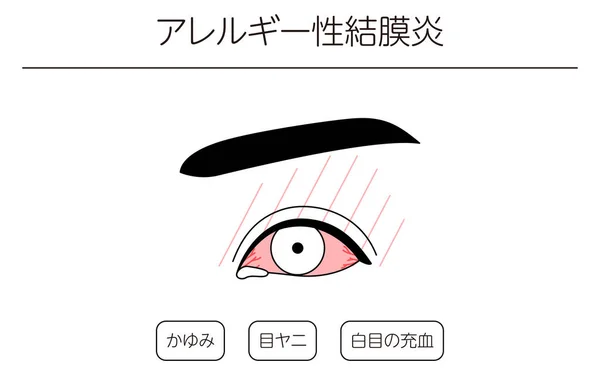 Medical Clipart Line Drawing Illustration Eye Disease Allergic Conjunctivitis Vector — Stock Vector