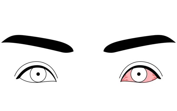 Clipart Médico Ilustración Trazado Líneas Enfermedad Ocular Conjuntivitis Ilustración Vectorial — Vector de stock