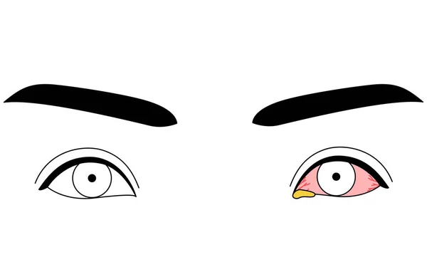 Clipart Médico Desenho Linha Ilustração Doença Ocular Conjuntivite Bacteriana Ilustração — Vetor de Stock