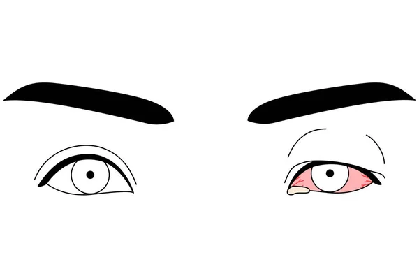 Clipart Médico Ilustração Desenho Linha Doença Ocular Conjuntivite Viral Ilustração — Vetor de Stock
