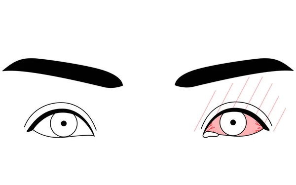 Kliparty Medyczne Rysunek Linii Ilustracja Choroby Oczu Alergicznego Zapalenia Spojówek — Wektor stockowy