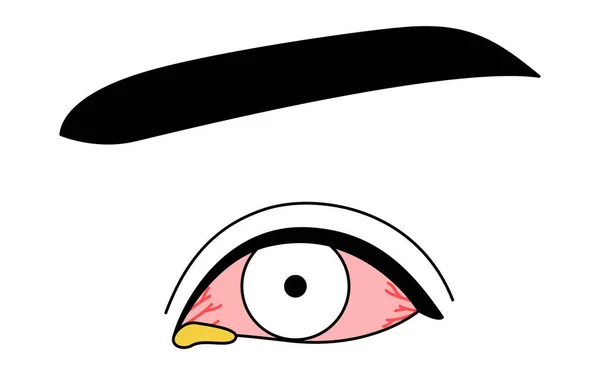 Kliparty Medyczne Rysunek Linii Ilustracja Choroby Oczu Bakteryjnego Zapalenia Spojówek — Wektor stockowy