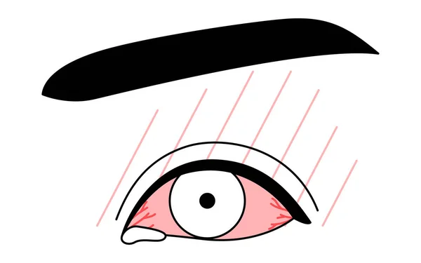 Inggris Medical Clipart Line Drawing Illustration Eye Disease Allergic Conjunctivitis - Stok Vektor