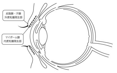 Tıbbi illüstrasyon, göz hastalığı ve mononükleoz kaynağının anatomik çizimi - Çevirisi: Sebaceous ve ter bezeleri harici habis granülomatöz salgı bezi oluşum alanı, Meibomian bezi Endomesenchymal granüloma geliştirme ar