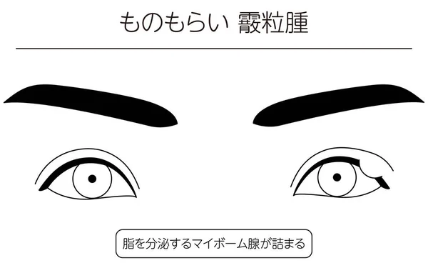 Medical Clipart Line Drawing Illustration Eye Disease Sty Chalazia Terjemahan - Stok Vektor