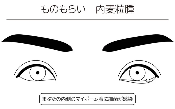 Medical Clipart Line Drawing Illustration Eye Disease Sty Hordeolum Internum - Stok Vektor