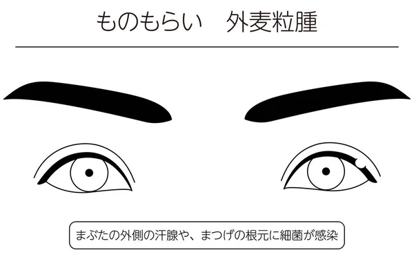 Medical Clipart Line Drawing Illustration Eye Disease Sty External Hordeolum — стоковый вектор