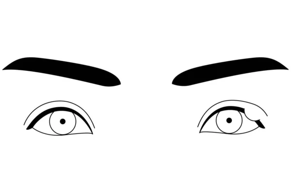 Clipart Médico Ilustração Desenho Linha Doença Ocular Sty Chalazia Ilustração — Vetor de Stock