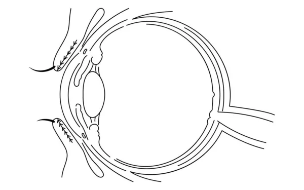 Ilustração Médica Desenho Anatômico Local Origem Doença Ocular Mononucleose Ilustração —  Vetores de Stock