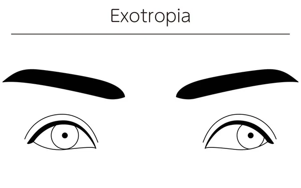 stock vector Medical illustrations, diagrammatic line drawings of eye diseases, strabismus and exotropia, Vector Illustration