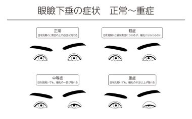 Tıbbi İllüzyon, Ptosis Belirtileri Normalden Şiddetli 'ye - Çevirisi: Tıbbi İllüzyon, Ptosis Belirtileri Şiddete Normal, Gözlerin açıldığında, gözün üzerindeki beyaz kısım görülebilir. Gözlerini açarken, göz kapağı gözü kapatır ama gözü kapatmaz.