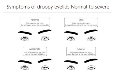 Tıbbi İllüzyon, Ptosis Semptomları Normal 'den Şiddetli' ye - Çevirisi: Gözü açarken, gözün üstündeki beyaz kısım görünür. Gözlerini açarken, göz kapağı gözü kapatır ama gözbebeğini kapatmaz. Gözlerini açtığında bile, gözbebeğinin bir parçası... 