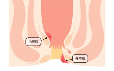 Diseases of the anus, hemorrhoids and warts Illustrations, cross-sectional views - Translation: Internal hemorrhoid nuclei, external hemorrhoid nuclei