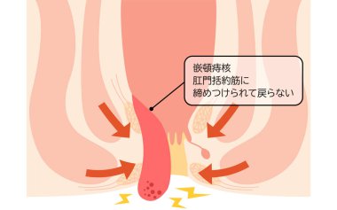 Diseases of the anus, hemorrhoids and warts 