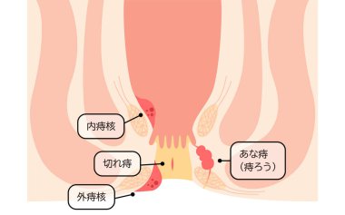 Diseases of the anus, hemorrhoids, warts, cut hemorrhoids, anorectal hemorrhoids Illustration, cross-sectional view - Translation: hemorrhoids, warts, cut hemorrhoids, anorectal hemorrhoids