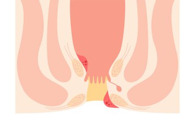 Diseases of the anus, hemorrhoids and warts Illustrations, cross-sectional views, Vector Illustration