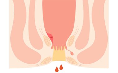 Diseases of the anus, hemorrhoids and warts 