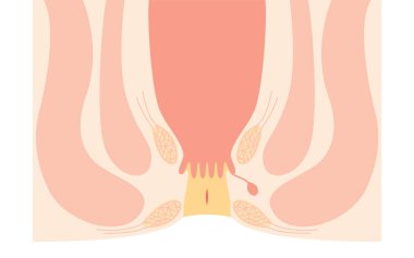 Diseases of the anus, hemorrhoids 