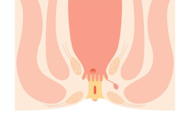 Diseases of the anus, hemorrhoids 