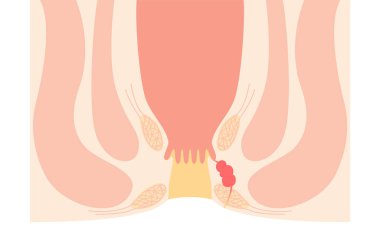 Diseases of the anus, hemorrhoids 