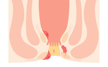 Diseases of the anus, hemorrhoids, warts, cut hemorrhoids, anorectal hemorrhoids Illustration, cross-sectional view, Vector Illustration