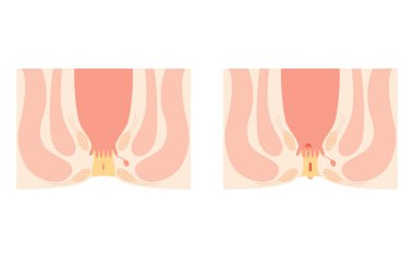 Diseases of the anus, hemorrhoids 