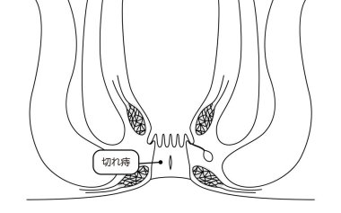 Diseases of the anus, hemorrhoids 