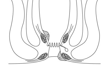 Diseases of the anus, hemorrhoids and warts Illustrations, cross-sectional views, Vector Illustration