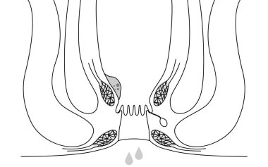 Diseases of the anus, hemorrhoids and warts 