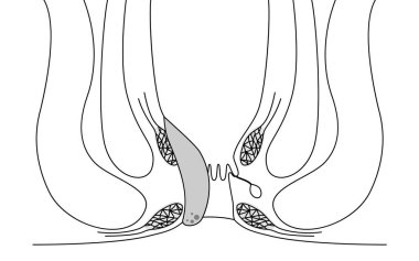 Diseases of the anus, hemorrhoids and warts 