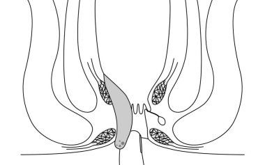 Diseases of the anus, hemorrhoids and warts 