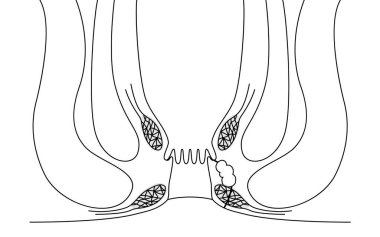 Diseases of the anus, hemorrhoids 