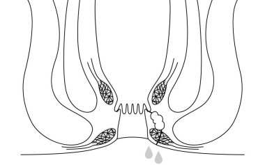 Diseases of the anus, hemorrhoids 