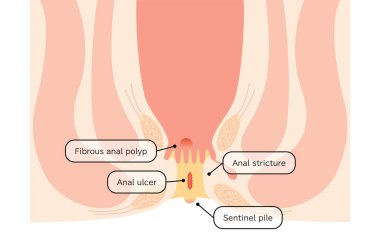 Diseases of the anus, hemorrhoids 