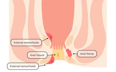 Diseases of the anus, hemorrhoids, warts, cut hemorrhoids, anorectal hemorrhoids Illustration, cross-sectional view - Translation: hemorrhoids, warts, cut hemorrhoids, anorectal hemorrhoids