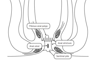 Diseases of the anus, hemorrhoids 